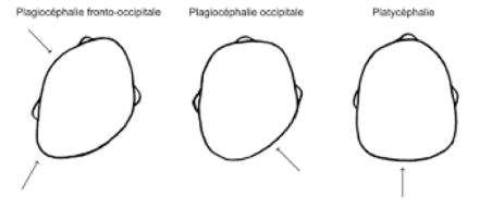 plagiocéphalie